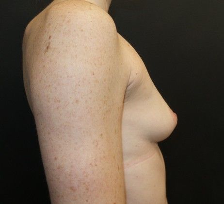 Natural Breast Augmentation with Fat: Case 4 - After