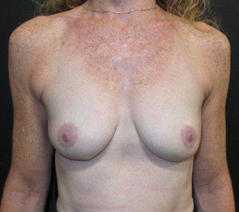 Natural Breast Augmentation with Fat: Case 3 - After