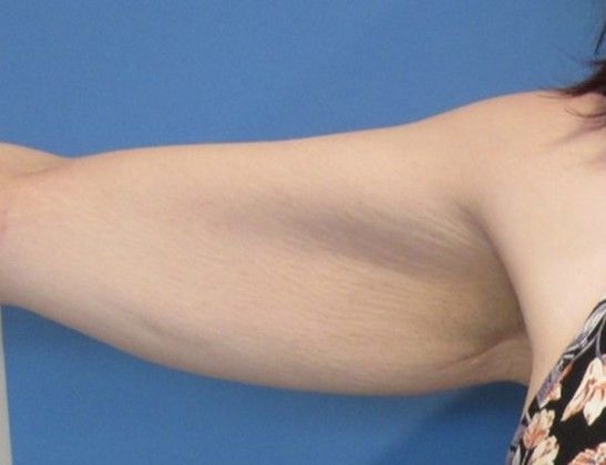 Arm Lift: Case 4 - Arm Lift, Fairfield - Before