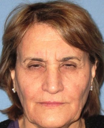 Ptosis Repair: Glendale Mueller Success - Before