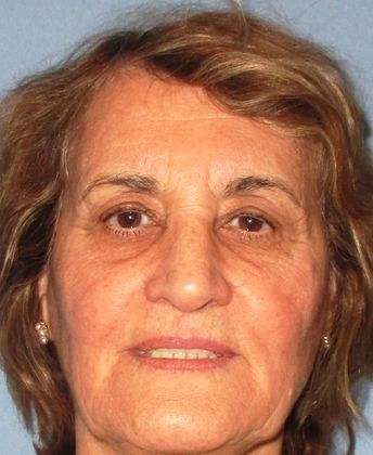 Ptosis Repair: Glendale Mueller Success - After