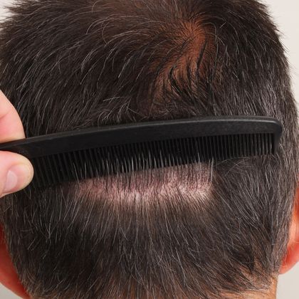 Donor Area After Hair Transplant Photos FUT