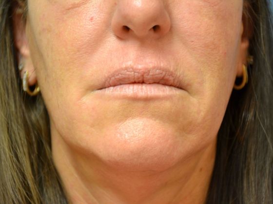 Botox® and Fillers VB1623 - Maumee, OH - Before