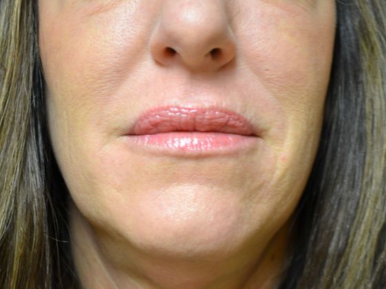 Botox® and Fillers VB1623 - Maumee, OH - After