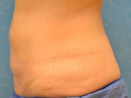 Coolsculpt: CS1321 - Toledo, OH - Before