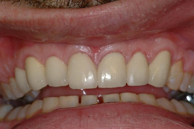 Crown Lengthening: Functional Crown Lengthening of Worn Upper Teeth - New Crowns Placed