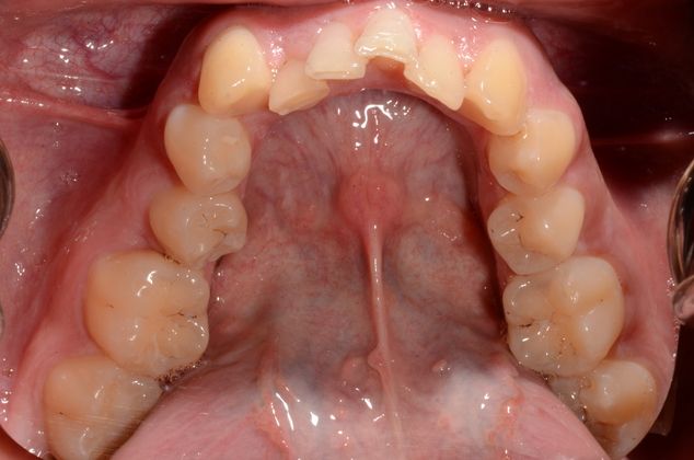 Invisalign: Case 4 - Before
