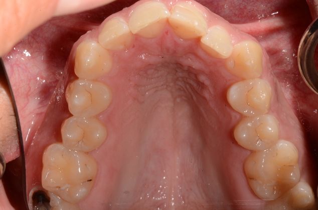 Invisalign: Case 4 - Before