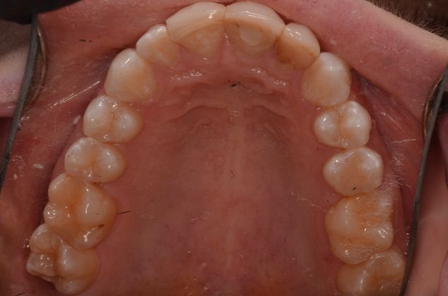 Invisalign Case 5 - After