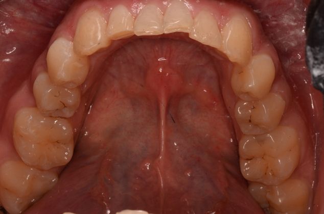 Invisalign: Case 4 - After