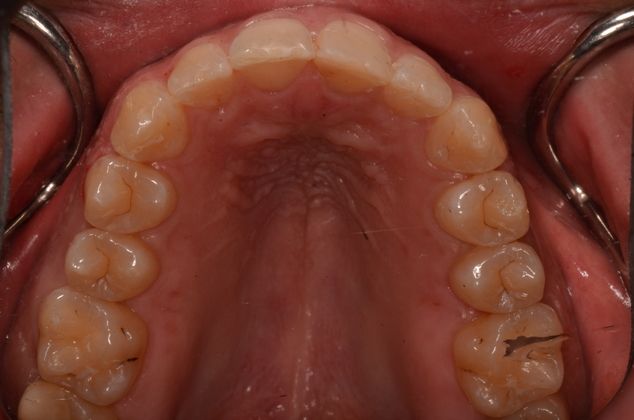 Invisalign: Case 4 - After