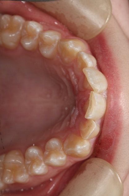 Invisalign Case 5 - Before