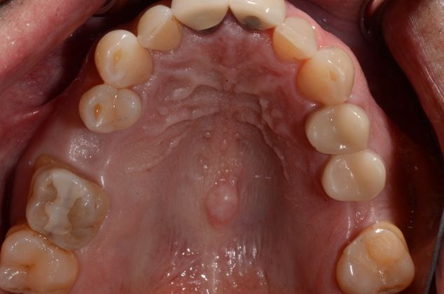 Dental Implants Case 1 - Before