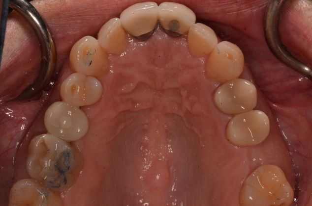 Dental Implants Case 1 - After