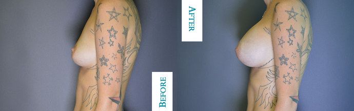 Breast Augmentation: Case 10 - After