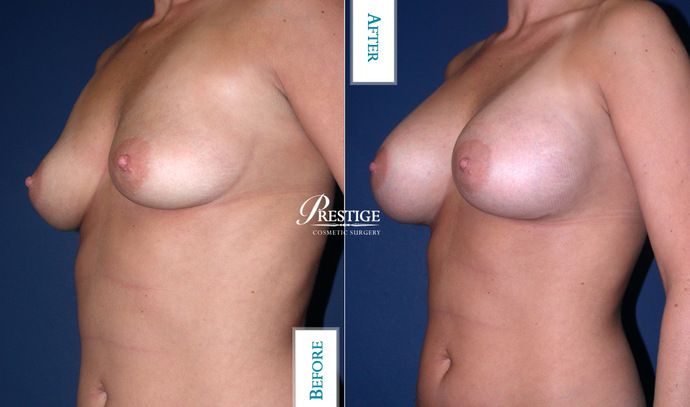 Breast Augmentation Case 17