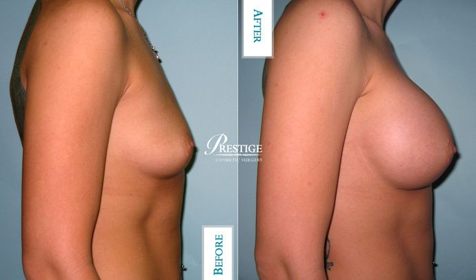 Breast Augmentation Case 18