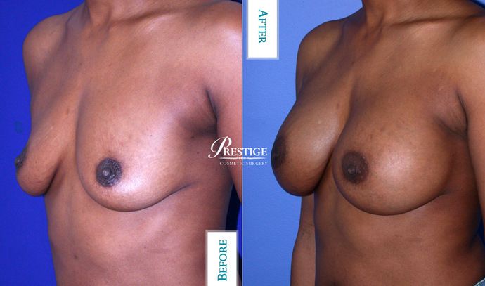 Breast Augmentation Case 19