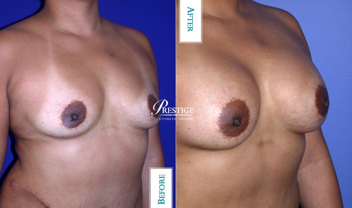 Breast Augmentation Case 21