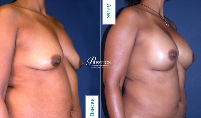 Breast Augmentation Case 22