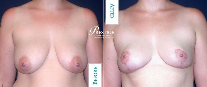 Breast Lift Case 6