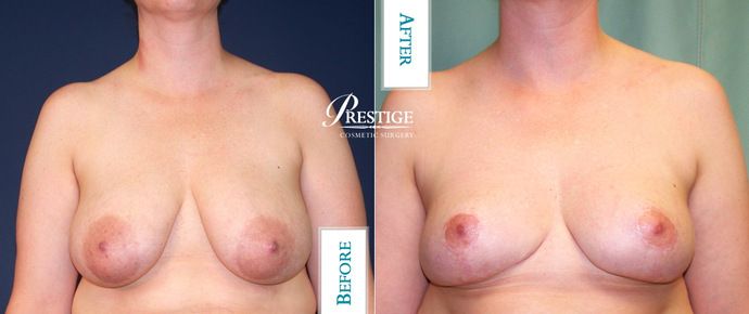 Breast Lift Case 7