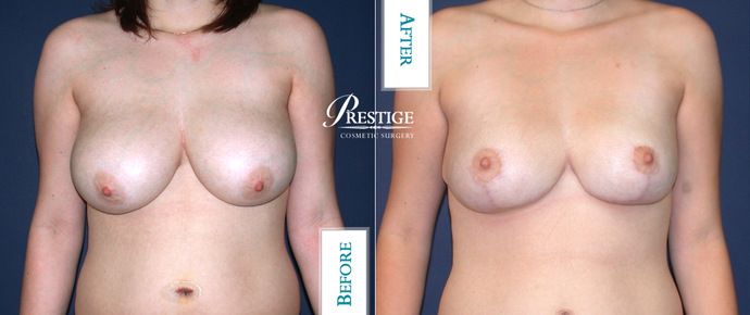 Breast Lift Case 9