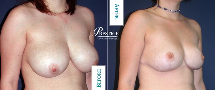 Breast Lift: Case 9 - Before
