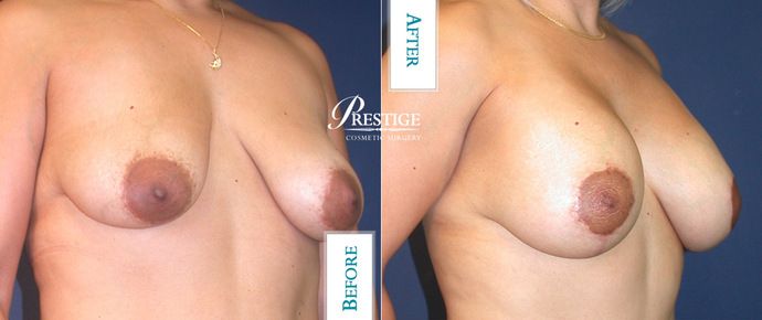 Breast Lift: Case 10 - Before