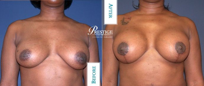 Breast Lift Case 11