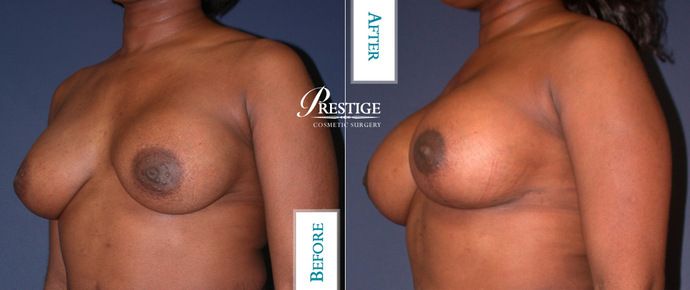 Breast Lift: Case 11 - Before