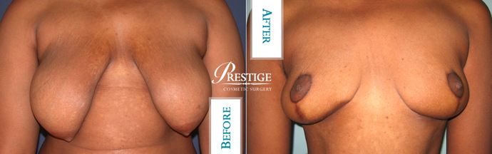 Breast Lift Case 14