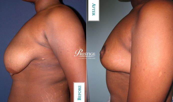 Breast Lift: Case 14 - Before