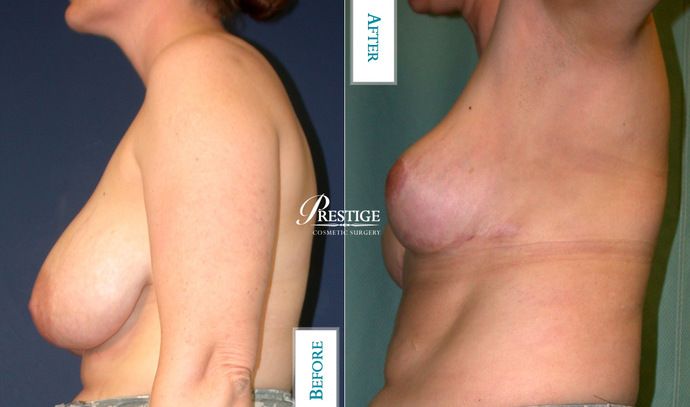 Breast Lift Case 18