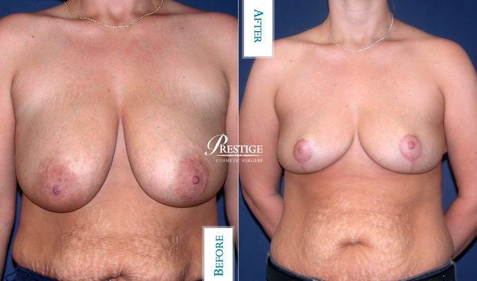 Breast Lift Case 19
