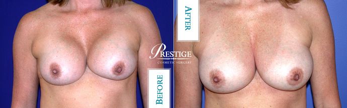 Revision Breast Surgery Case 1