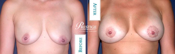 Breast Augmentation Case 24