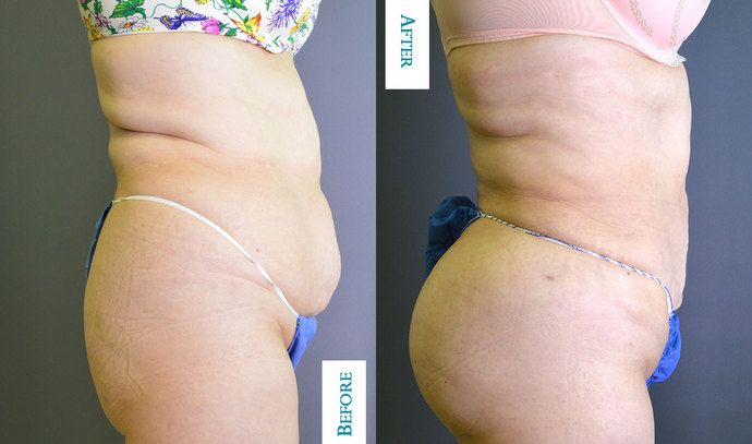 Liposuction Case 7