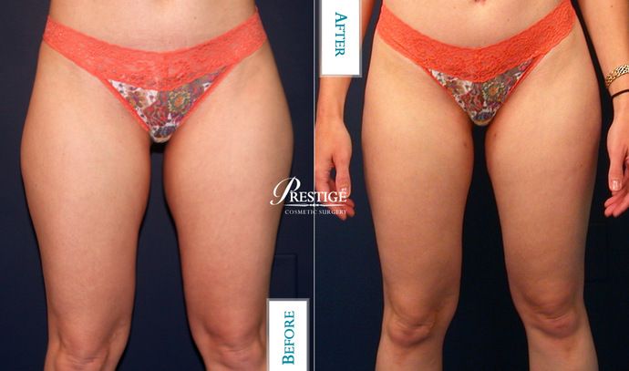 Liposuction: Case 8 - Before