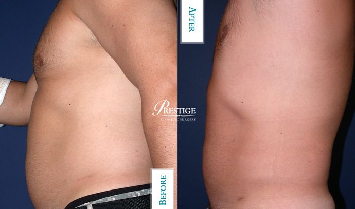 Liposuction Case 9