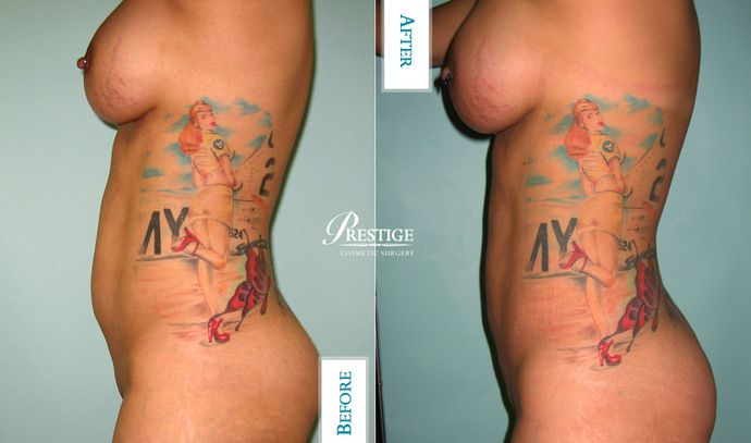 Liposuction Case 10