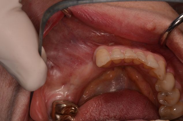 Dental Implants: Case 2 - Before