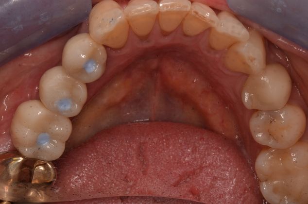 Dental Implants: Case 2 - After