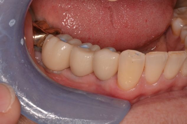 Dental Implants: Case 2 - After