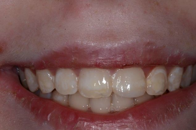 Smile Makeover Case : Montgomery County - Before