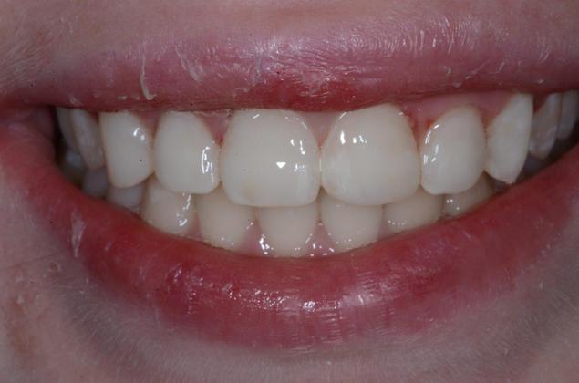 Smile Makeover Case : Montgomery County - After