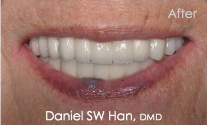 After full mouth reconstruction