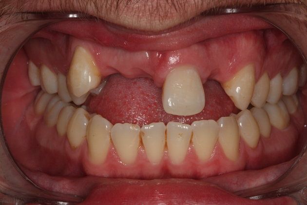 Dental Implants: Case 3 - Before