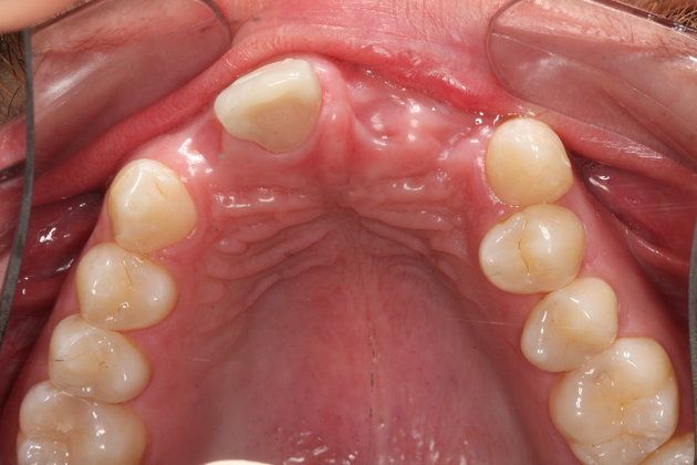 Dental Implants: Case 3 - Before