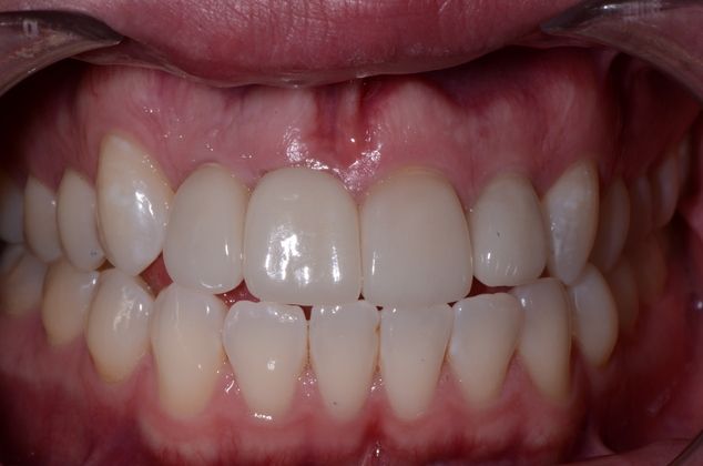 Dental Implants: Case 3 - After